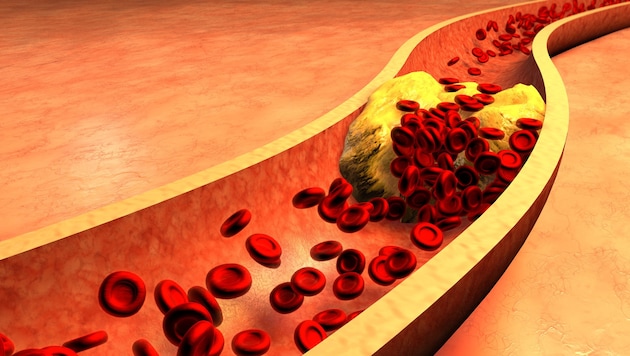 High cholesterol levels can cause deposits to form in the blood vessels. Heart attack threatens1 (Bild: ralwel/stock.adobe.com)