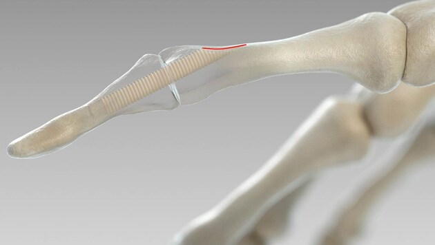Grafische Darstellung einer Knochenschraube im Fingergelenk (Bild: APA/SURGEBRIGHT)
