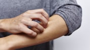 Rauchen und Alkohol können einen Schub auslösen. (Bild: miamariam/stock.adobe.com)
