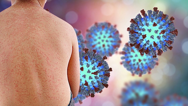 Measles cases on the rise in Austria. (Bild: stock.adobe.com, krone.at-Grafik)