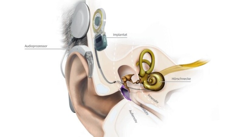 Der Schall wird in elektrische Impulse umgewandelt, die ins Innenohr geleitet werden. (Bild: MED-EL)