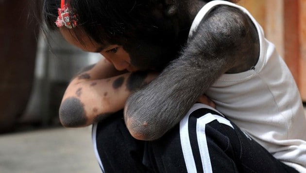 Ein am „Werwolf“-Syndrom leidendes Mädchen (Bild: AP/dpa/Zhui Ying)