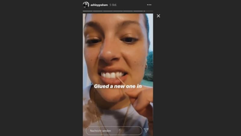 Ashley Graham zeigt in ihren Insta-Storys, dass sie ihren abgebrochenen Vorderzahn wieder angeklebt hat. (Bild: instagram.com/ashleygraham)