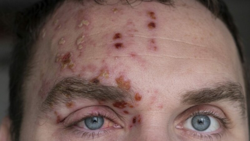 Bei Herpes Zoster kommt es häufig zu einem streifenförmigen Ausschlag mit Hautbläschen auf einer Körperseite. Aber auch ein Befall des Gesichtes ist möglich. (Bild: Yury/stock.adobe.com)