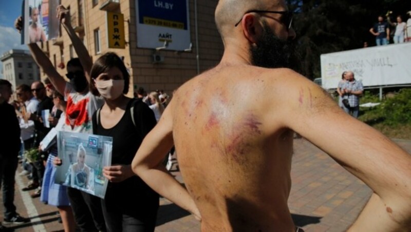 Dieser Mann zeigt Verletzungen, die ihm in der Haft nach den eskalierten Demonstrationen zugefügt wurden. (Bild: AP)