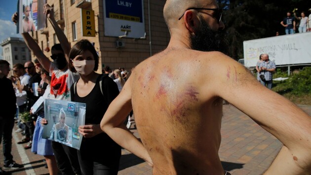 Dieser Mann zeigt Verletzungen, die ihm in Belarus in der Haft zugefügt wurden. (Bild: AP)