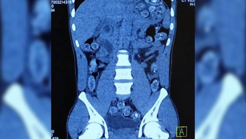 Ein Nigerianer nutzte sich selbst als Schmuggelbehältnis. Der sogenannte Bodypacker war mit 214 (!) verschluckten Päckchen Kokain und Heroin im Körper in Wien gelandet. (Bild: BMF/Zoll, krone.at)