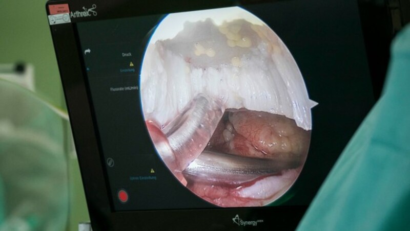 Mittels Arthroskopie werden die selbsthaftenden Zellkügelchen an die beschädigte Knorpelstelle transplantiert. (Bild: Orthopädischen Spital Speising)