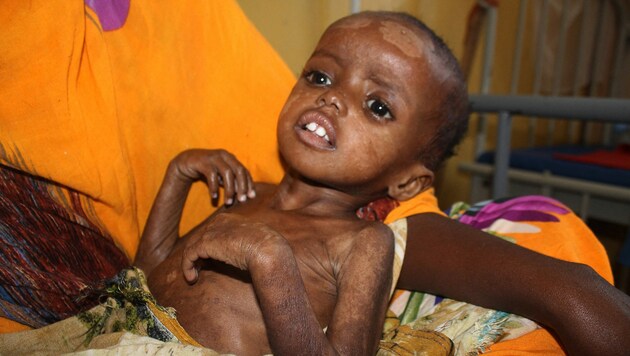 Ein schwer unterernährtes Mädchen in einem Spital in Mogadischu in Somalia (Bild: AFP/Abdifitah Hashi Nor)