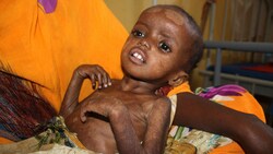 Ein schwer unterernährtes Mädchen in einem Spital in Mogadischu in Somalia (Bild: AFP/Abdifitah Hashi Nor)