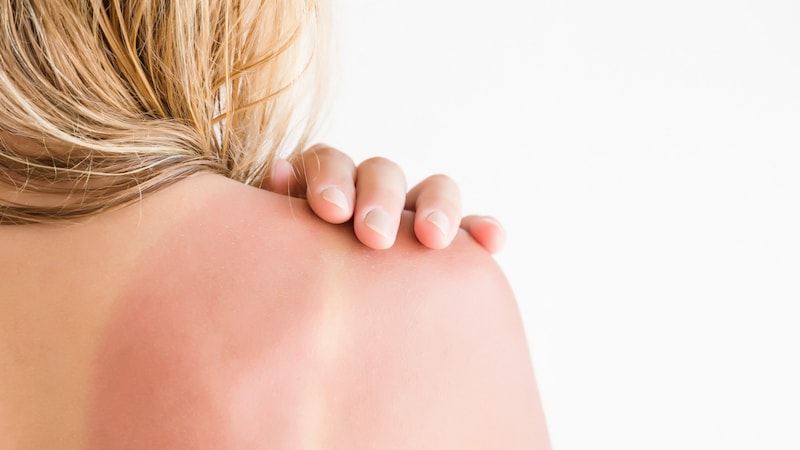 Too much sun increases the risk of developing skin cancer. (Bild: fotoduets/stock.adobe.com)