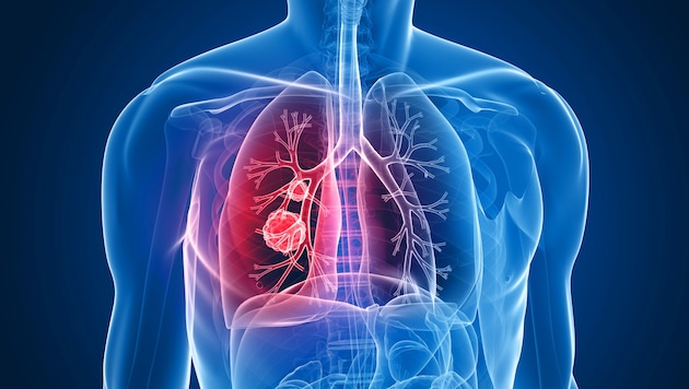 Lungenkrebs zählt zu den tödlichsten Tumorerkrankungen. (Bild: SciePro/stock.adobe.com)