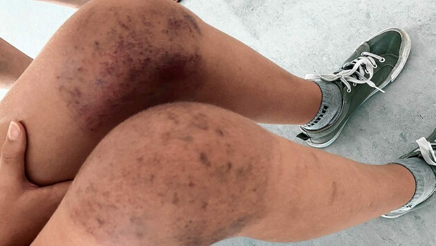 Übersät mit blauen Flecken: die verletzten Knie der 13-jährigen Schülerin aus Wien nach dem Pool-Unfall in Lignano (Bild: zVg)