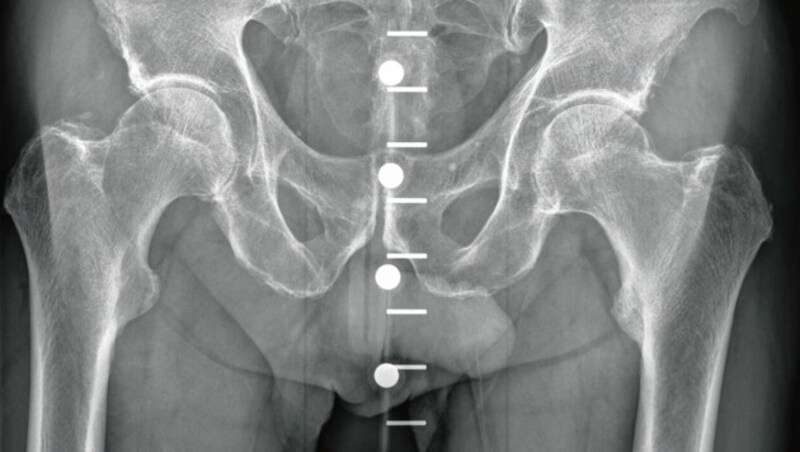 Stark abgenützte Hüftgelenke. (Bild: Nuhr/Steinbrecher)