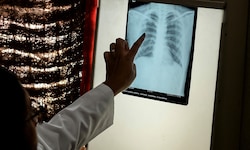 Röntgenaufnahme eines Patienten in Indien