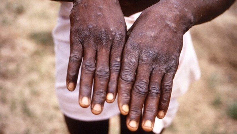 Bei Affenpocken kann sich ein Ausschlag entwickeln, der sich - oft ausgehend vom Gesicht - auf andere Körperteile, etwa auch auf die Hände, ausbreitet. (Bild: CDC)