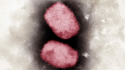 Elektronenmikroskopische und eingefärbte Aufnahme von zwei Affenpocken-Viren (Bild: APA/AFP/RKI/Andrea Maennel, Andrea Schnartendorff)