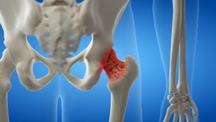 Auch bei Männern kann Osteoporose zu Knochenschäden (Bild: Schenkelhals) führen. (Bild: SciePro/stock.adobe.com)