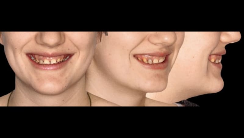 Betroffene haben durch zahnmedizinische Kunst und technische Meisterleistung wieder ein ganz normales Leben vor sich (Bild: Krone KREATIV; Zahnschmelz gesperrt! GEMA)