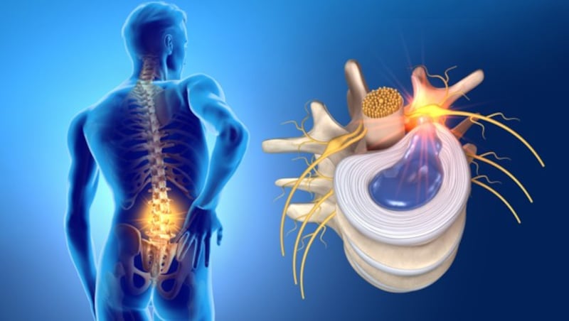 Meist kommt es in der Lendenwirbelsäule zu heftigen, ausstrahlenden Schmerzen, wenn Bandscheibengewebe „austritt“, da Nerven gereizt werden. (Bild: www.axelkock.de/stock.adobe.com)