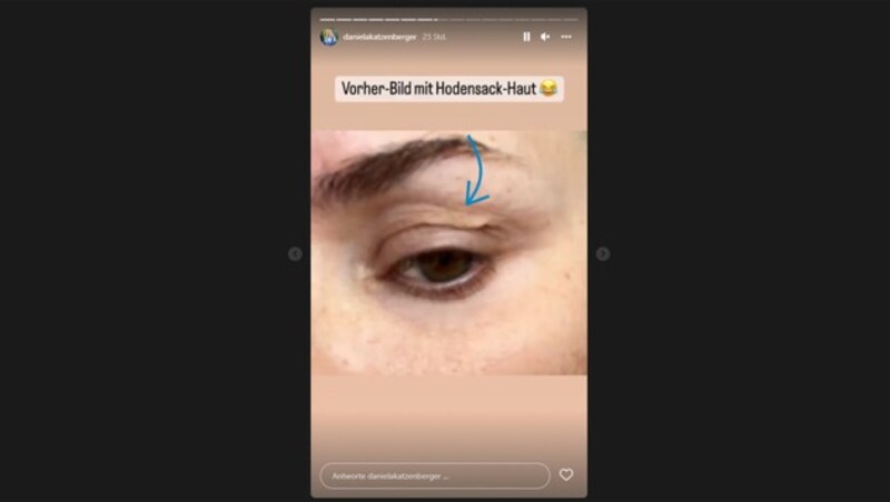 Daniela Katzenberger zeigte in ihrer Instagram-Story ein Foto mit ihrer „Hodensack-Haut“ am Lid, die sie sich nun operativ entfernen ließ. (Bild: instagram.com/danielakatzenberger)