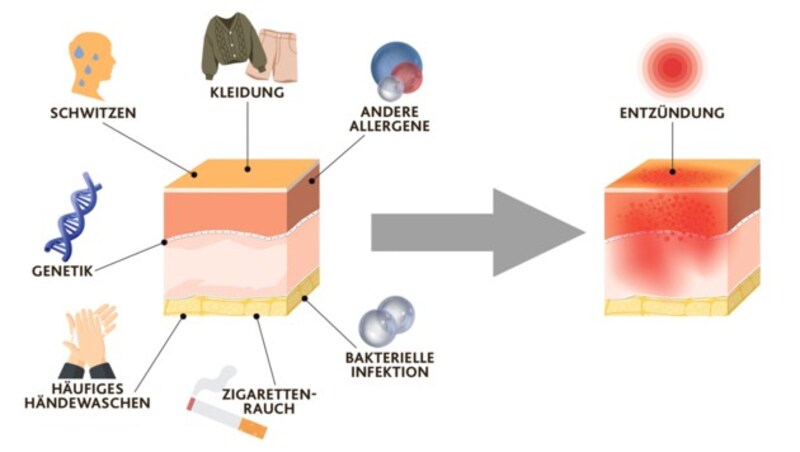 Bestimmte Faktoren führen zu einer Überreaktion des Immunsystems und in Folge zu Entzündungen. (Bild: Krone KREATIV, stock.adobe.com)