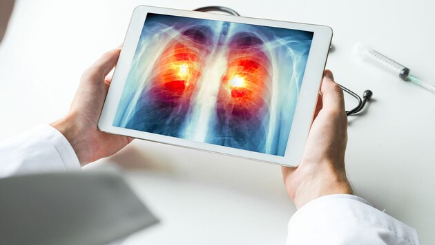 Experten fordern ein gezieltes Früherkennungsprogramm für Lungenkrebs (Bild: Krone KREATIV, stock.adobe.com)