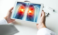 Jährlich werden rund 5000 Österreich mit Lungenkrebs diagnostiziert.