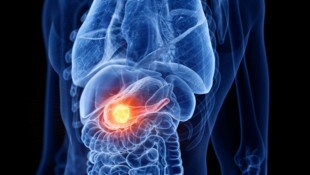 Las posibilidades de recuperación del cáncer de páncreas son extremadamente escasas.  (Imagen: SciePro - stock.adobe.com)