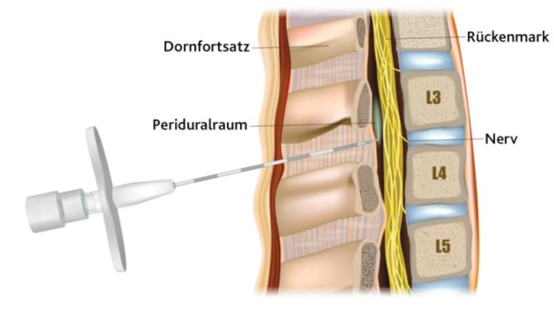 Peridural- oder Epiduralanästhesie (PDA): Um die Rückenmarksnerven zu betäuben, spritzt der Anästhesist ein Medikament in den Bereich (Liquorraum) um das Rückenmark. Dadurch wird die Signalübertragung ins Gehirn unterbrochen. (Bild: Krone KREATIV, sakurra - stock.adobe.com)