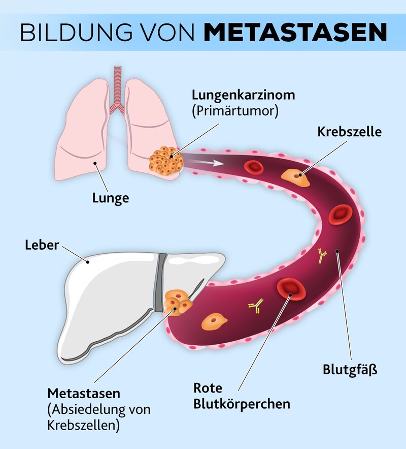 Las células cancerosas pueden viajar por el torrente sanguíneo a otras zonas del cuerpo, colonizarlas y formar metástasis. (Bild: Krone KREATIV, stock.adobe.com)