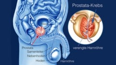 Prostatakrebs ist die zweithäufigste Todesursache bei Männern über 60 Jahren. (Bild: Krone KREATIV,Adobe Stock, )