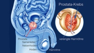 Prostatakrebs ist die zweithäufigste Todesursache bei Männern über 60 Jahren. (Bild: Krone KREATIV,Adobe Stock, )