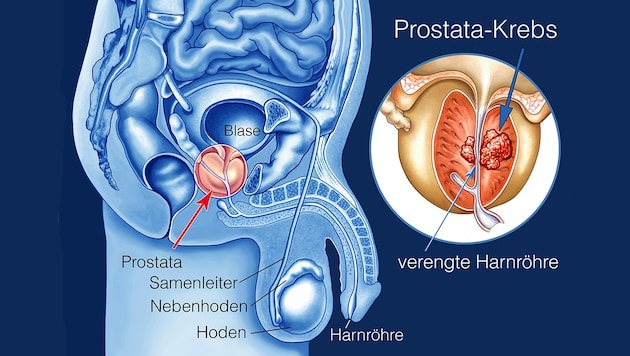 Prostate cancer is the second most common cause of death in men over the age of 60. (Bild: Krone KREATIV,Adobe Stock, )