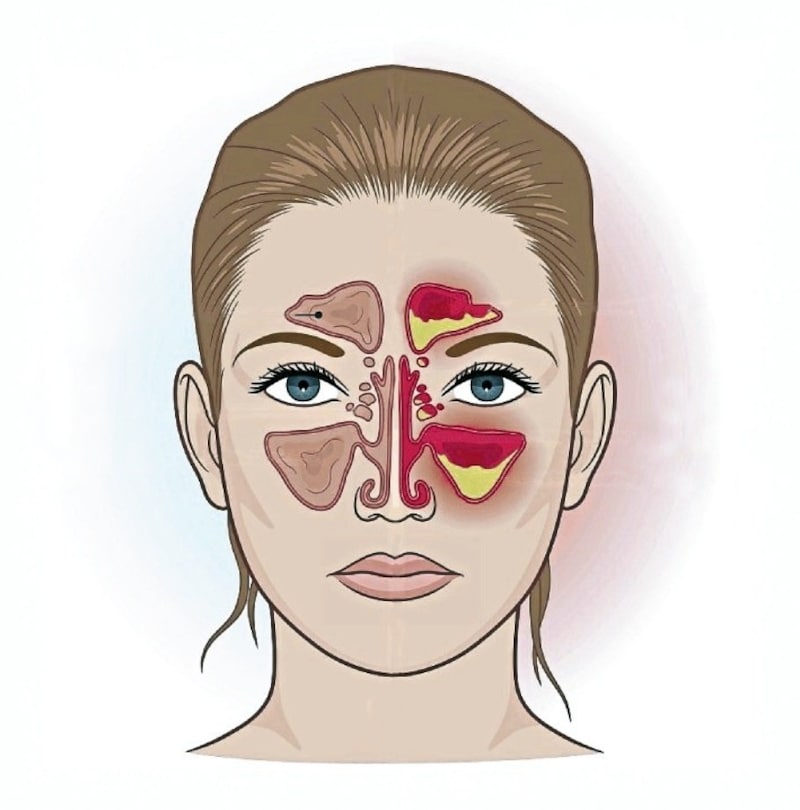 Links gesunde Nebenhöhlen, rechts entzündete (Sinusitis). (Bild: stock.adobe.com)