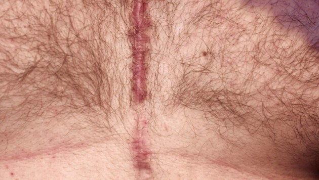 La cicatriz de la operación de Georg H.  Se dice que un puñetazo lo golpeó aquí también.  (Imagen: Holl Reinhard)