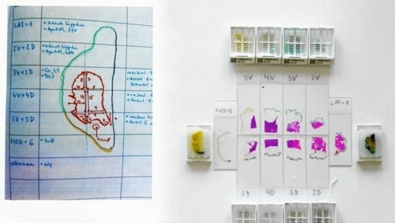 Verschiedene Gewebepräparate von einem Patienten. Sie sind Tausendstel Millimeter dünn. (Bild: Findl)