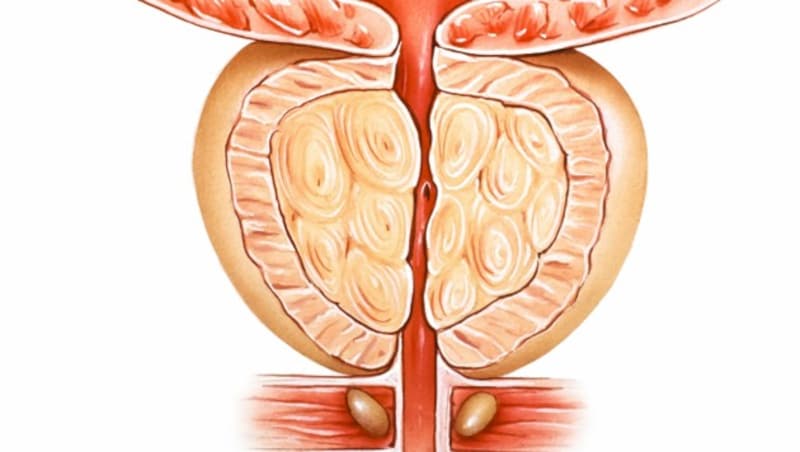 Die gutartige Prostatavergrößerung führt zu Harnentleerungsstörungen (Bild: © Judith Glick)