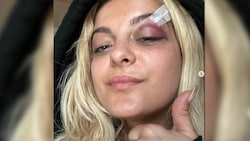 Nachdem sie auf der Bühne mit einem Handy beworfen wurde, zeigte sich Sängerin Bebe Rexha jetzt mit blauem Auge auf Instagram. (Bild: instagram.com/beberexha)