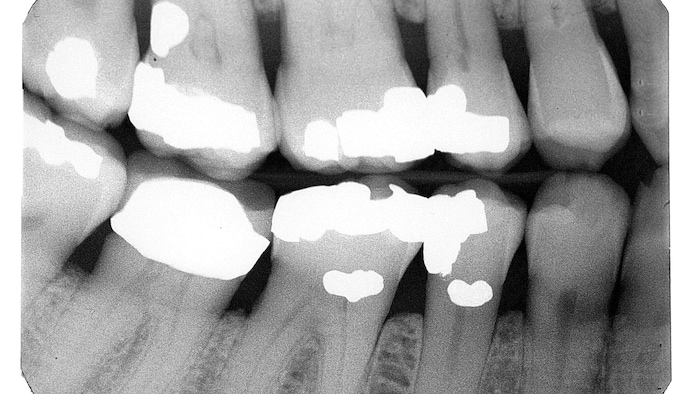 Die gesundheitlichen Langzeitfolgen von chronischen Belastungen durch Amalgam sind wissenschaftlich umstritten. Es wird etwa angenommen, dass sie kontinuierlich kleine Mengen Quecksilber freisetzen.