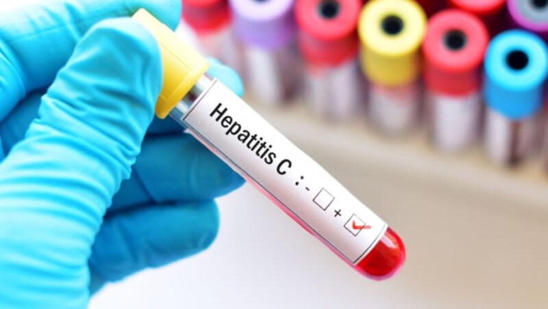 Screening auf Hepatitis mittels Bluttest wäre sinnvoll. (Bild: jarun011 - stock.adobe.com)