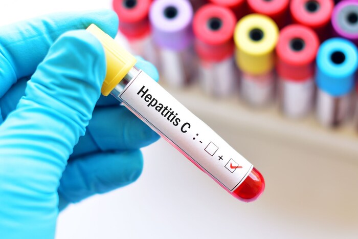 Screening auf Hepatitis mittels Bluttest wäre sinnvoll.
