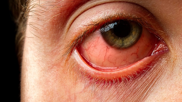 Auf jeder gesunden Augenoberfläche existieren Infektionserreger, doch durch Kontaktlinsen kann der schützende Tränenfilm beschädigt und der Eintritt von Bakterien, Pilzen oder Amöben ins Auge erhöht werden. (Bild: stock.adobe.com)