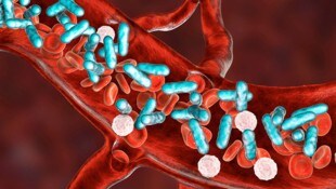 Bakterien richten nach einer Infektion im Blut großen Schaden an, Sepsis entsteht. (Bild: adobe.stock, Krone KREATIV)