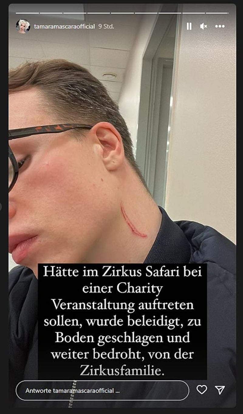 In ihrer Instagram-Story erhob Tamara Mascara schwere Vorwürfe gegen die Zirkusfamilie und zeigte ihre Verletzungen. (Bild: instagram.com/tamaramascaraofficial, Krone KREATIV)