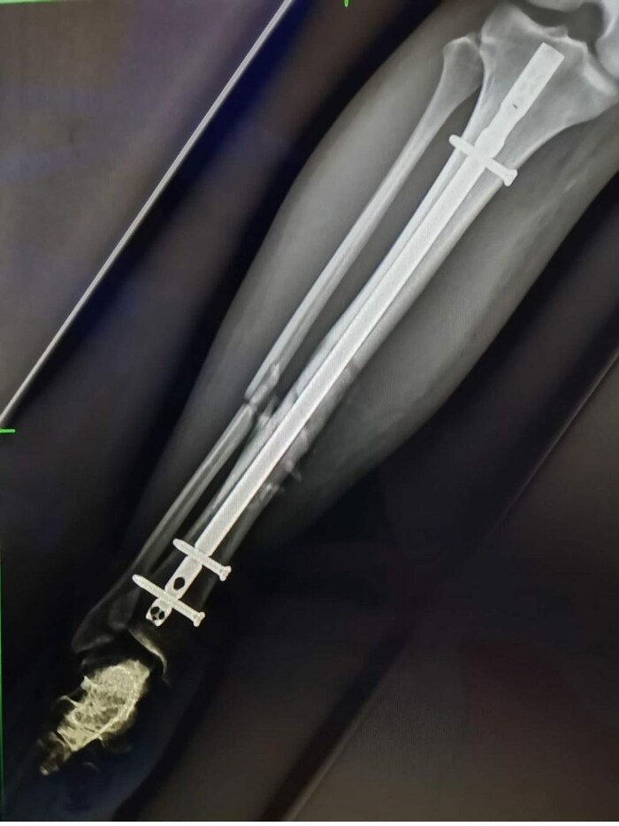 Bei dem Eingriff in den USA wurde Nußbaumer ein Marknagel eingesetzt.