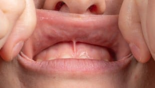 Das Lippenbändchen kann störende Auswirkungen haben. (Bild: Alessandro Grandini - stock.adobe.com)