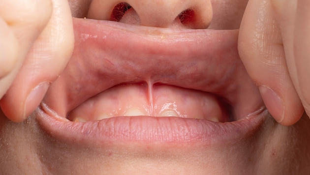 Das Lippenbändchen kann störende Auswirkungen haben. (Bild: Alessandro Grandini - stock.adobe.com)
