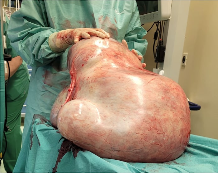 Trotz der enormen Ausmaße konnte der Tumor problemlos entfernt werden.
