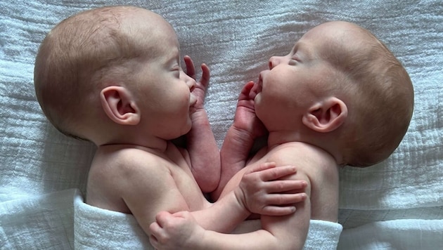 Die beiden Mädchen waren an Bauchwand und Lebern zusammengewachsen. (Bild: Universitätsklinikum Hamburg-Eppendorf (UKE))